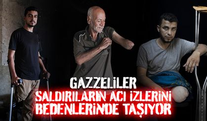 Gazze’deki siviller, işgalci saldırılarının acı izlerini bedenlerinde taşıyor