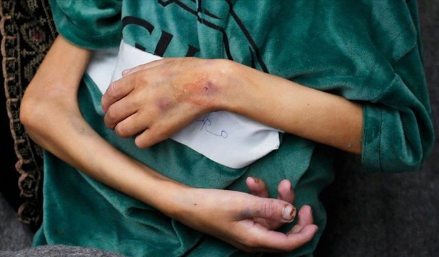 Katil İsrail'in saldırıları altındaki Gazze'de bir haftada 4 çocuk daha "açlıktan" öldü